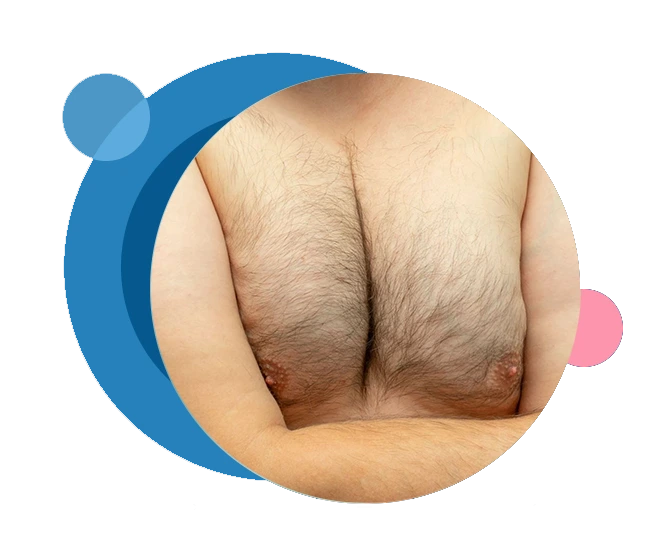 Gynecomastia Surgery