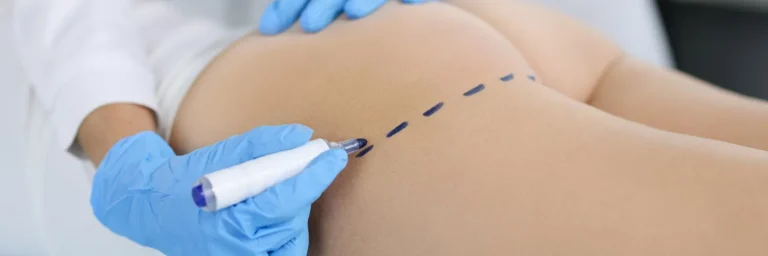 The Benefits of Buttock Augmentation: Understanding BBL